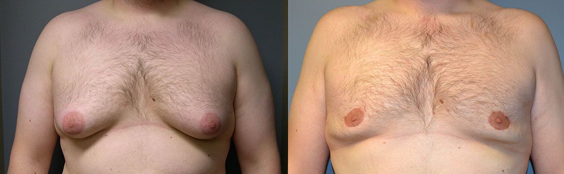 Gynaecomastia Surgery Before and After Barr Plastic Surgery