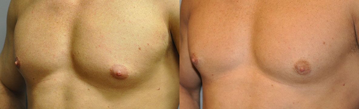 Gynaecomastia Surgery Before and After Barr Plastic Surgery